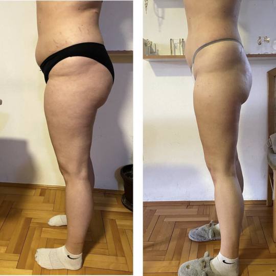 Beauty and nutrition #beograd Anticelulit masaža Anticelulit masaža Da li imate problem sa upornim