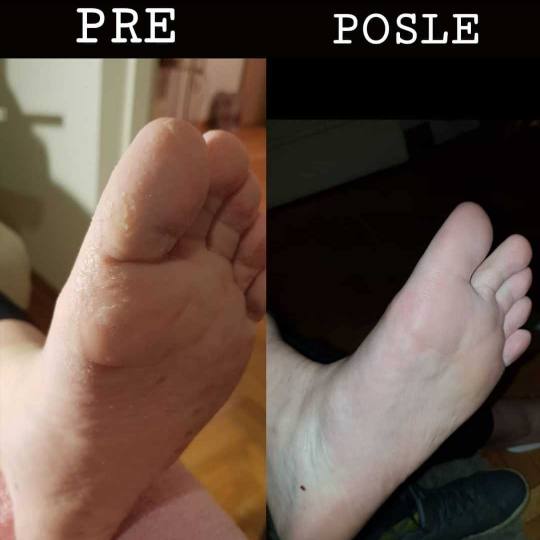 Just You Beauty & Nails #beograd Medicinski pedikir