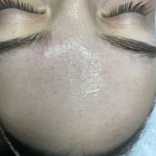 Prestige #beograd Tretman lica Hydra Facial Najsavršeniji letnji tretman, čišćenje, hidratacija 