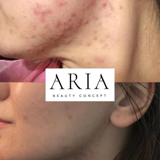 Aria Beauty Concept #pancevo Tretman lica Acne care tretman lica Serija tretmana