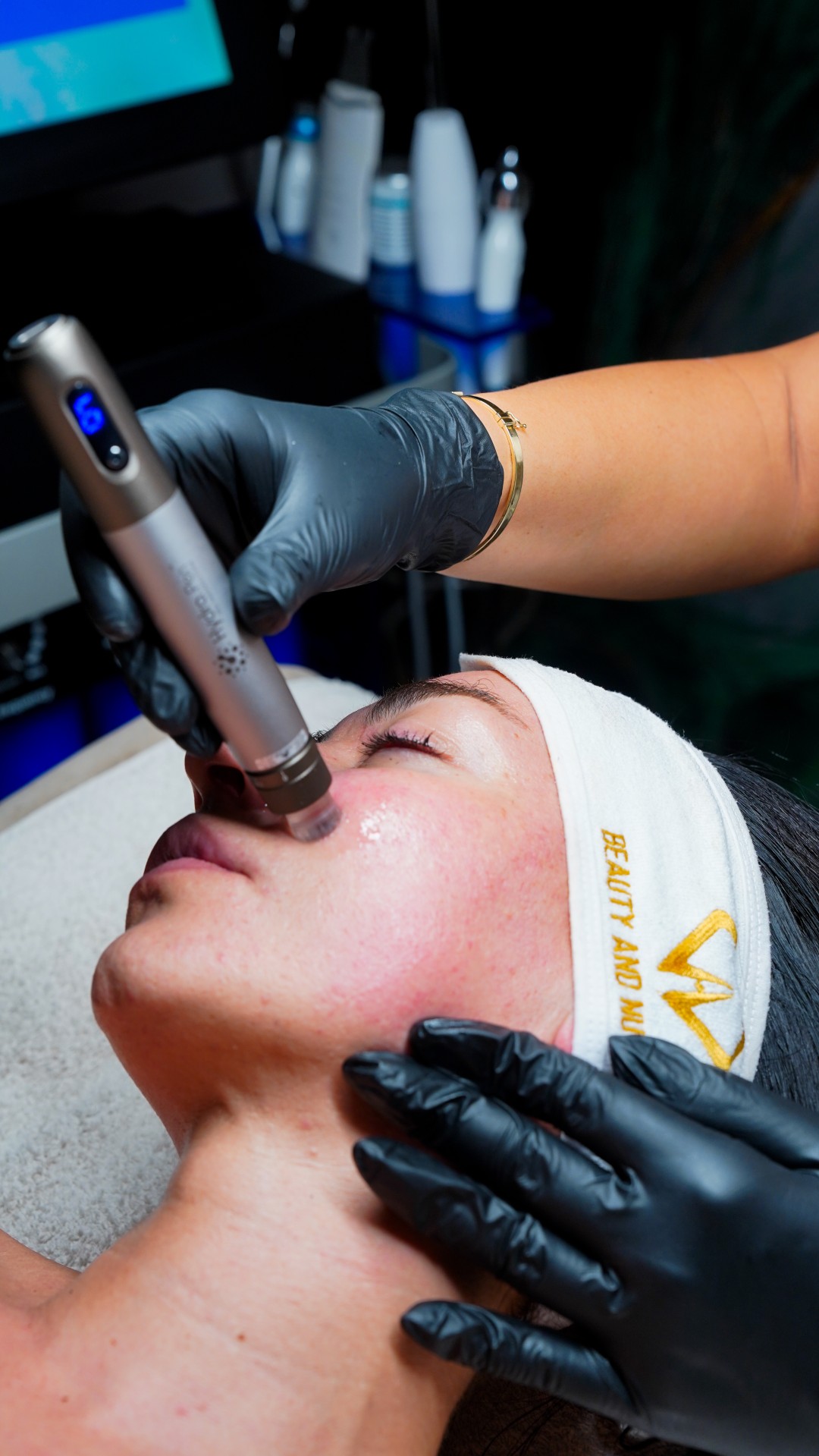 Dermapen tretman lica - Beauty and nutrition, Beograd Dermaroler i dermapen Lice Dermaroler i dermapen, Beograd, Zvezdara