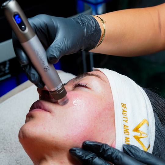 Beauty and nutrition #beograd Dermaroler i dermapen Dermapen tretman lica