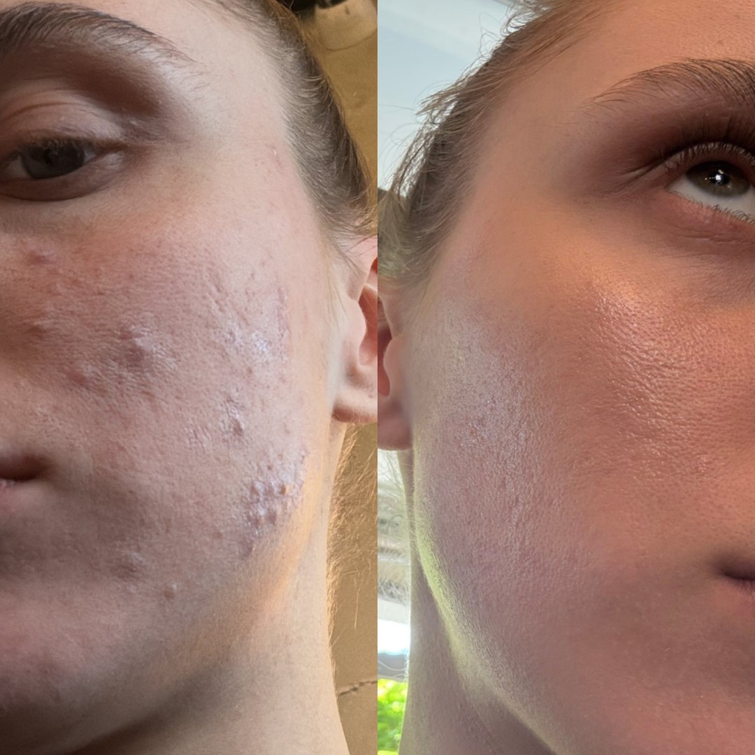 Studio joge i lepote Jelena Bilcar #beograd Tretman lica Mezoterapija + hemijski piling Mesoestetik