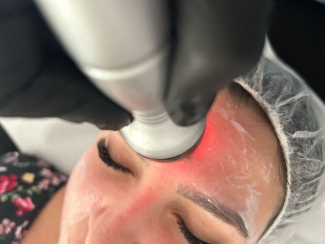 Esthetique Privé #beograd Kavitacija Kavitacija lica + RF lifting + Lipolaser