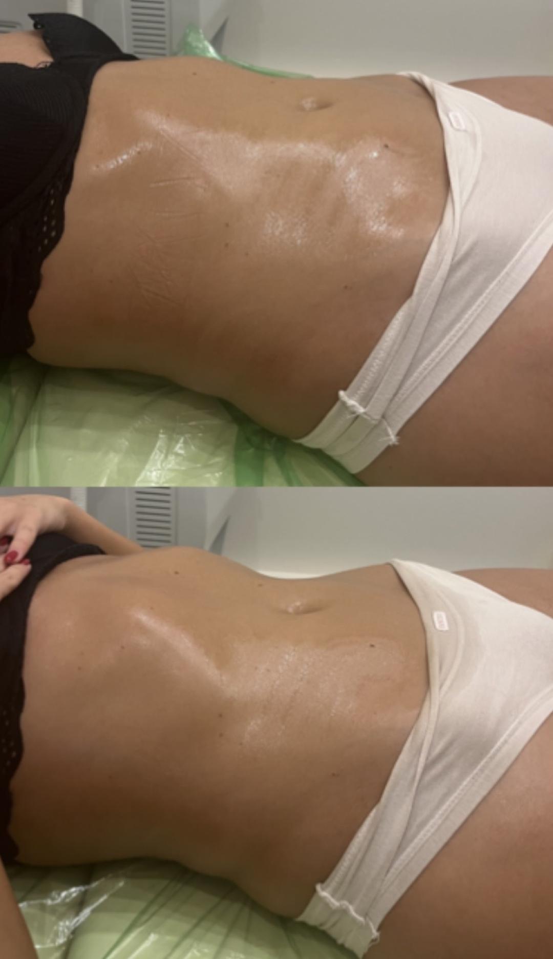 Diamond beauty #beograd Anticelulit masaža Vacum 65 body + limfna drenaža