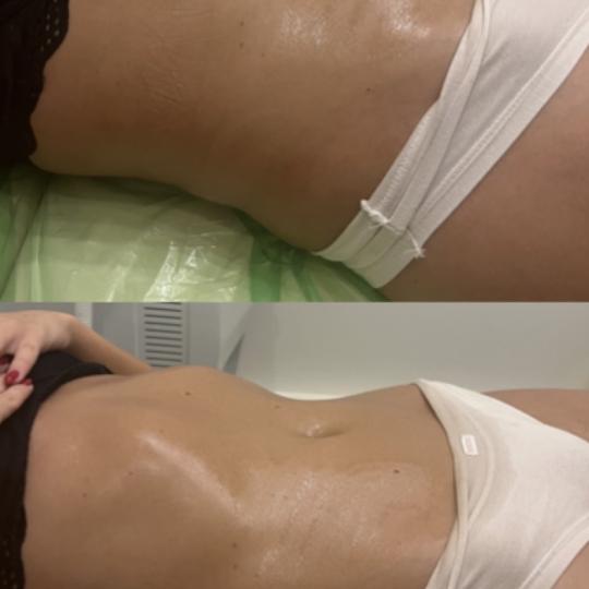 Diamond beauty #beograd Anticelulit masaža Vacum 65 body + limfna drenaža Masaža