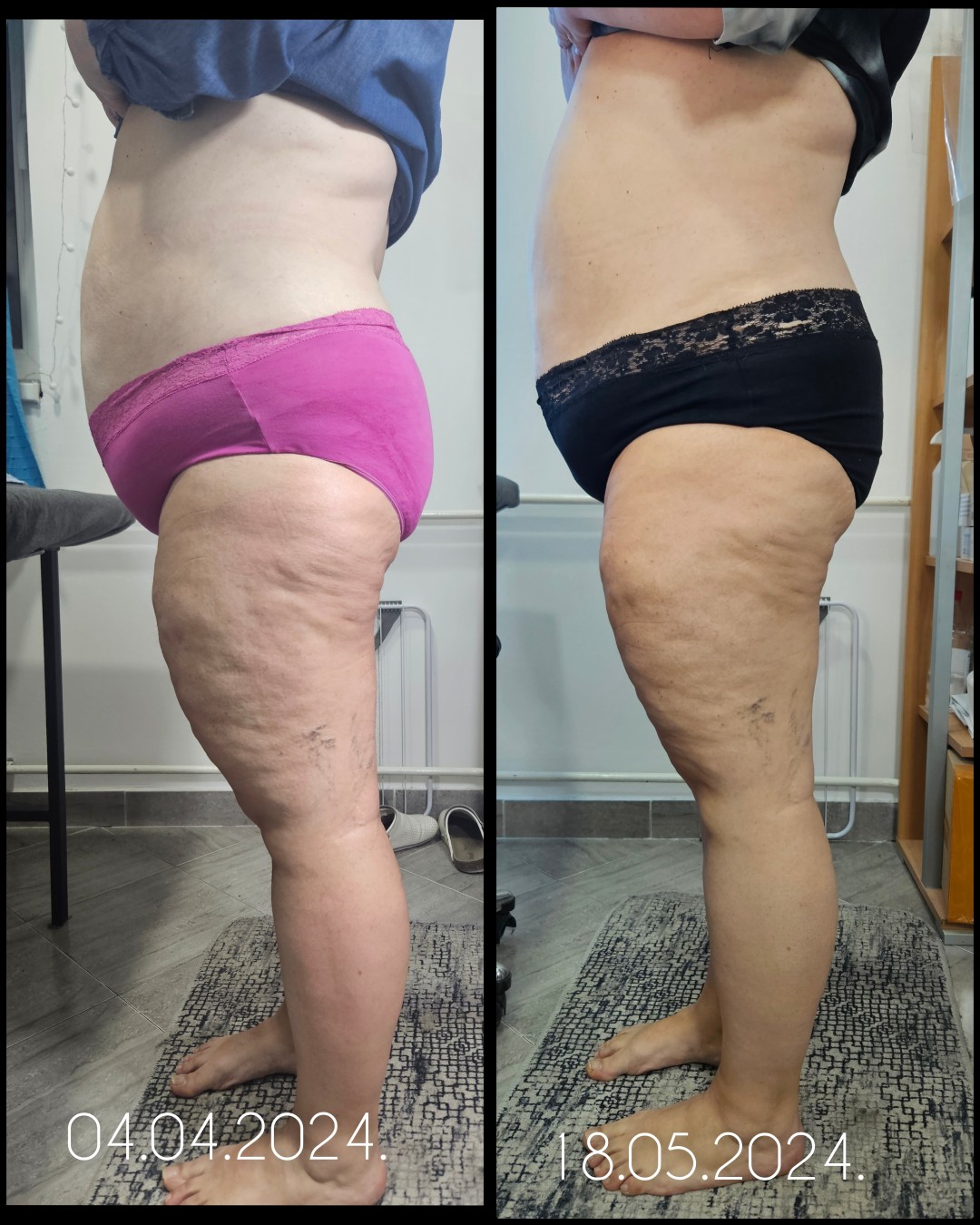 Beauty salon XL Lady #beograd Kavitacija Kavitacija + radiotalasni lifting / vakum - paket od 8 tretmana