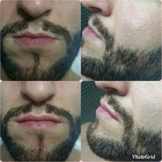 Maximus 1 #nis Hijaluronski tretmani lica Korekcija volumena gornje usne Hijaluronski fileri (1 ml)