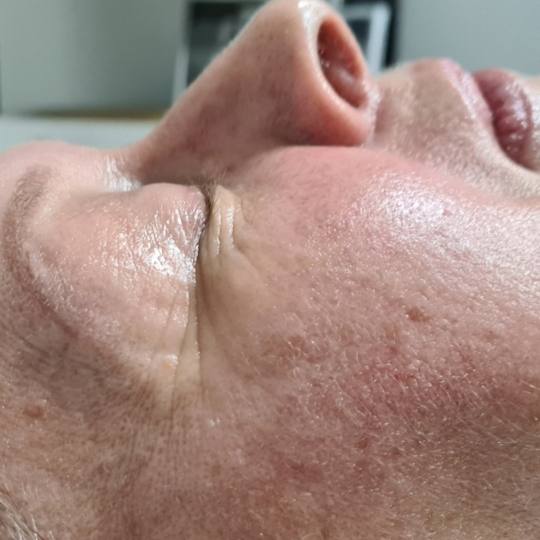 SunBox #beograd Masaža lica Face gym / Face fitness - anti age masaža lica
