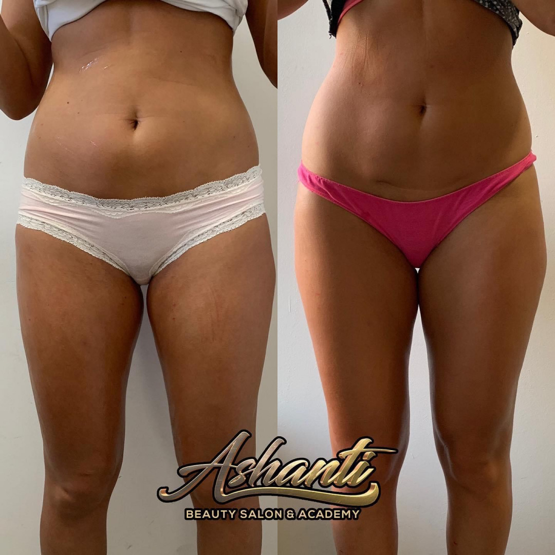 Ashanti Beauty Salon & Academy #beograd Masaža za mršavljenje Vacuslim 48 / Vacuumfit - stomak + bokovi + noge - paket od 5 tretmana