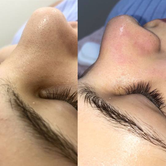 Makeup Olja Grbić #novisad Tretman lica Čišćenje lica ultrazvučnom špatulom Primer kalo  UZ š