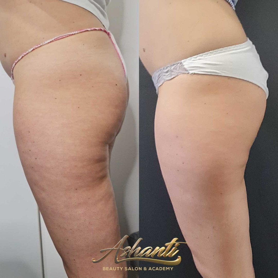 Ashanti Beauty Salon & Academy #beograd Kavitacija Ultrazvučna kavitacija / radiotalasni lifting po regiji - paket od 10 tretmana