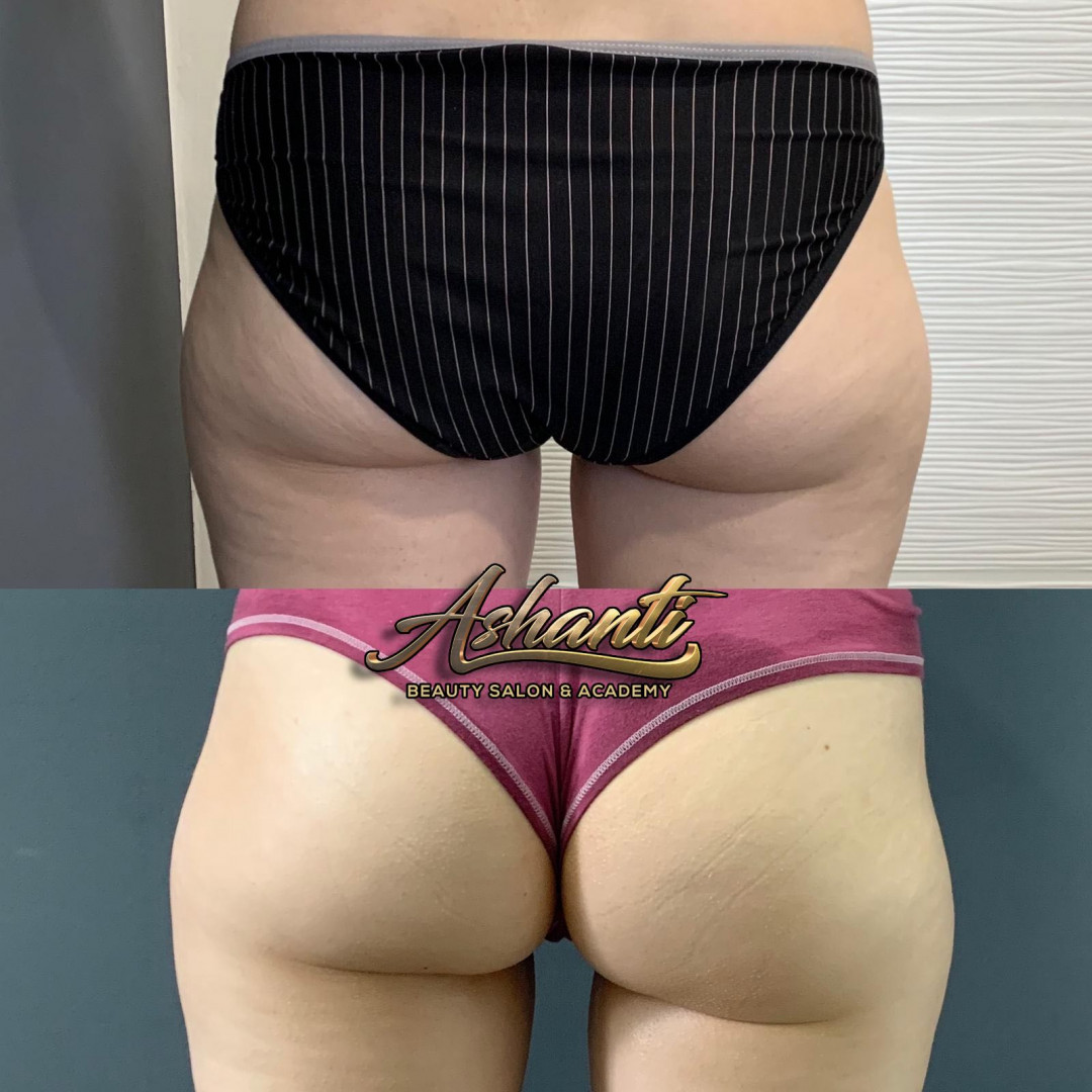 Ashanti Beauty Salon & Academy #beograd Masaža za mršavljenje