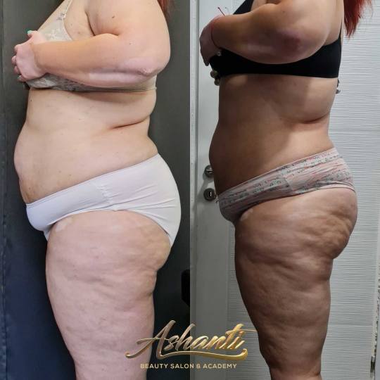 Ashanti Beauty Salon & Academy #beograd Masaža za mršavljenje Vacuslim 48 / Vacuumfit - stomak + b