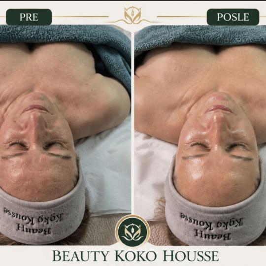 Beauty Koko Housse - Vračar #beograd Tretman lica Kolagen tretman + hemijski piling - letnji Lice