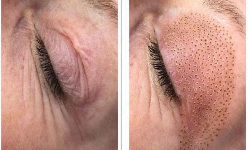 Vila Beauty Studio #beograd Tretman lica Plasma pen (po regiji)