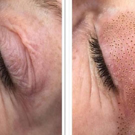 Vila Beauty Studio #beograd Tretman lica Plasma pen (po regiji)