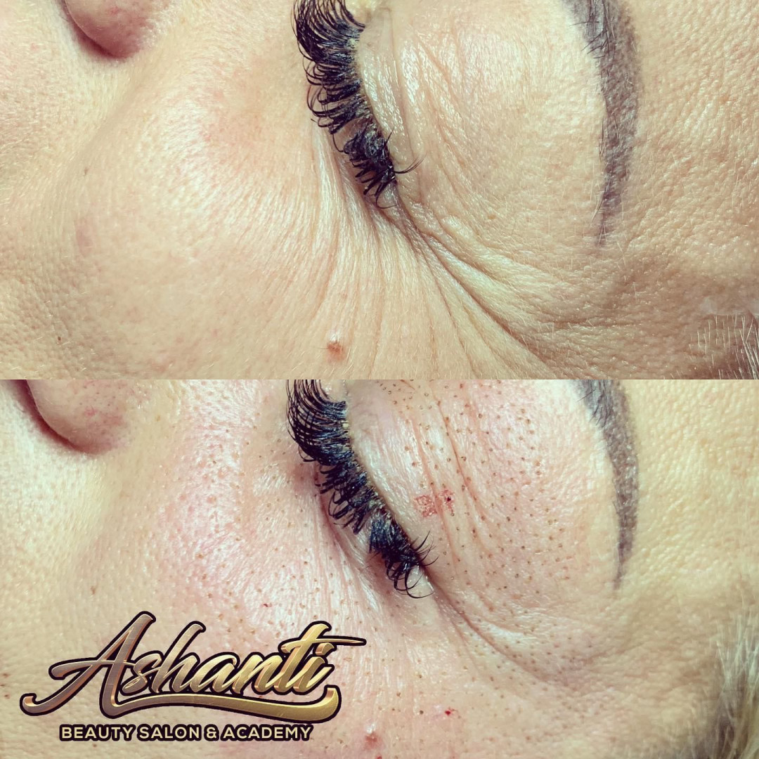 Plasma pen - podočnjaci - Ashanti Beauty Salon & Academy, Beograd Tretman lica Lice Tretman lica, Beograd, Voždovac