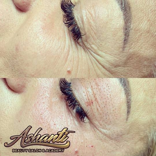 Ashanti Beauty Salon & Academy #beograd Tretman lica Plasma pen - podočnjaci