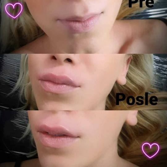 Golden Duo massage & Wellness studio #beograd Tretman lica Hijaluronpen Punjenje usana 1ml hijaluron