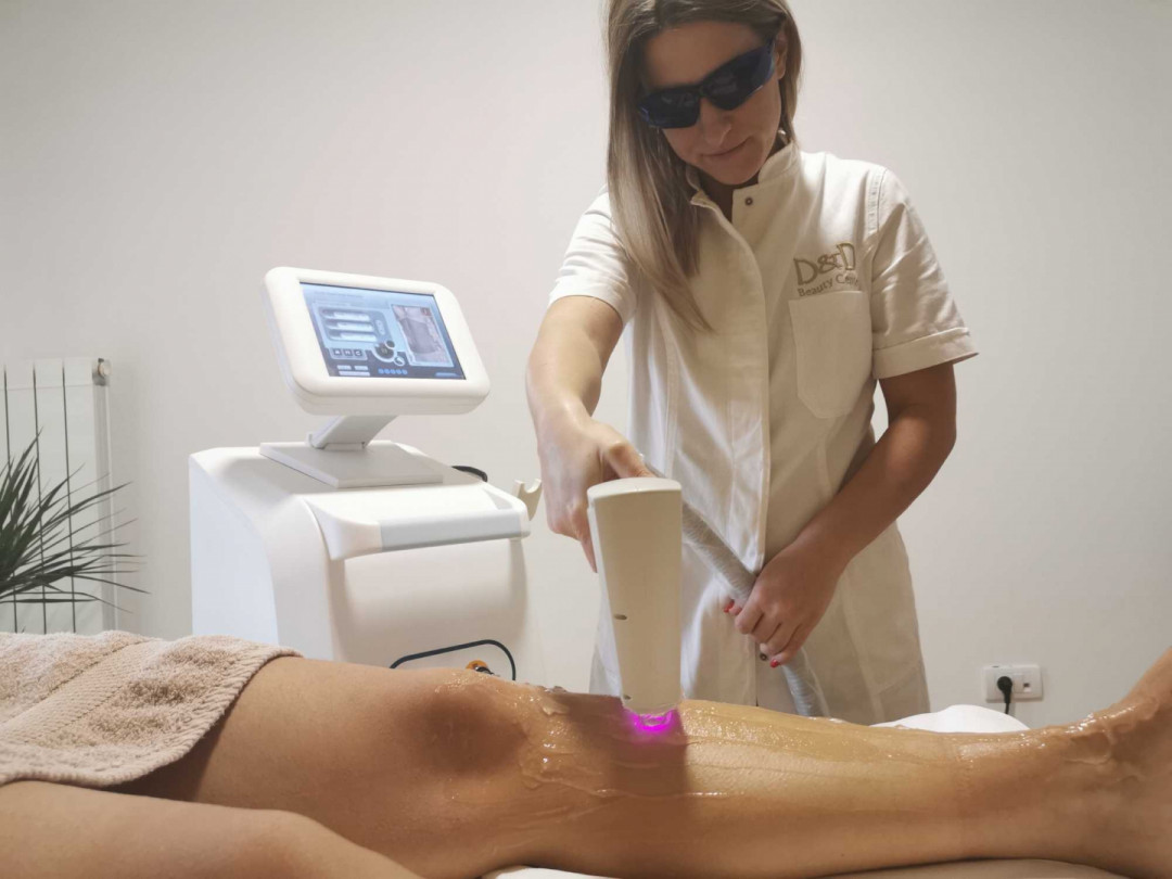 D&D Beauty Center #beograd Laserska epilacija Laserska epilacija celih nogu + brazilska laserska epilacija - za dame