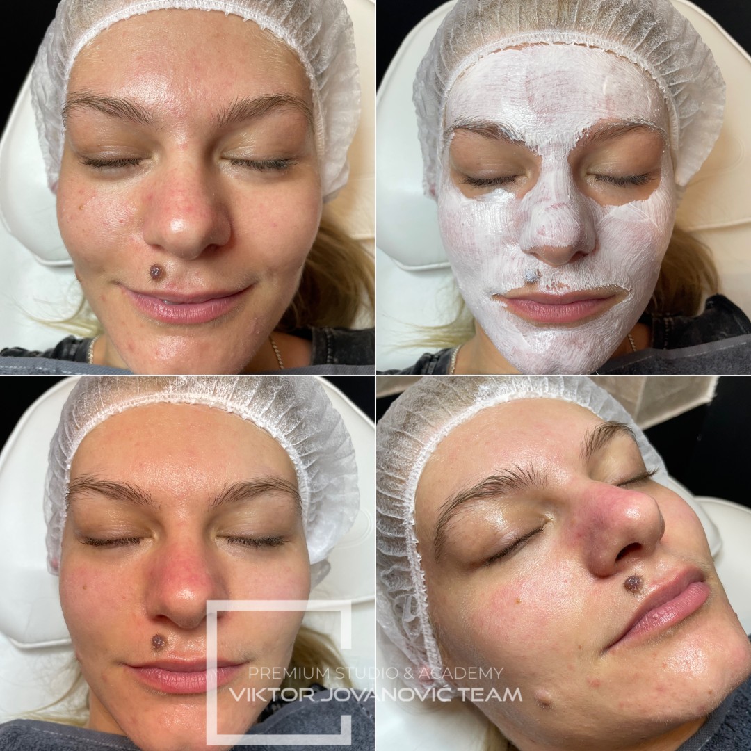 Hemijski AHA piling lica - BEAUTY CENTER Viktor Jovanović, Subotica Tretman lica Lice Tretman lica, Subotica, Centar