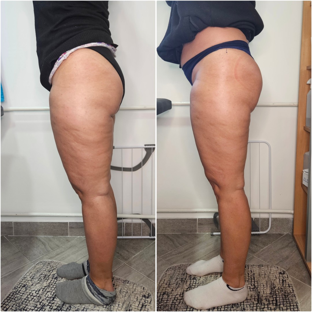 Beauty salon XL Lady #beograd Anticelulit masaža Vakuum brazilski gluteus - 20 + 10 minuta - paket od 5 tretmana + 1 gratis