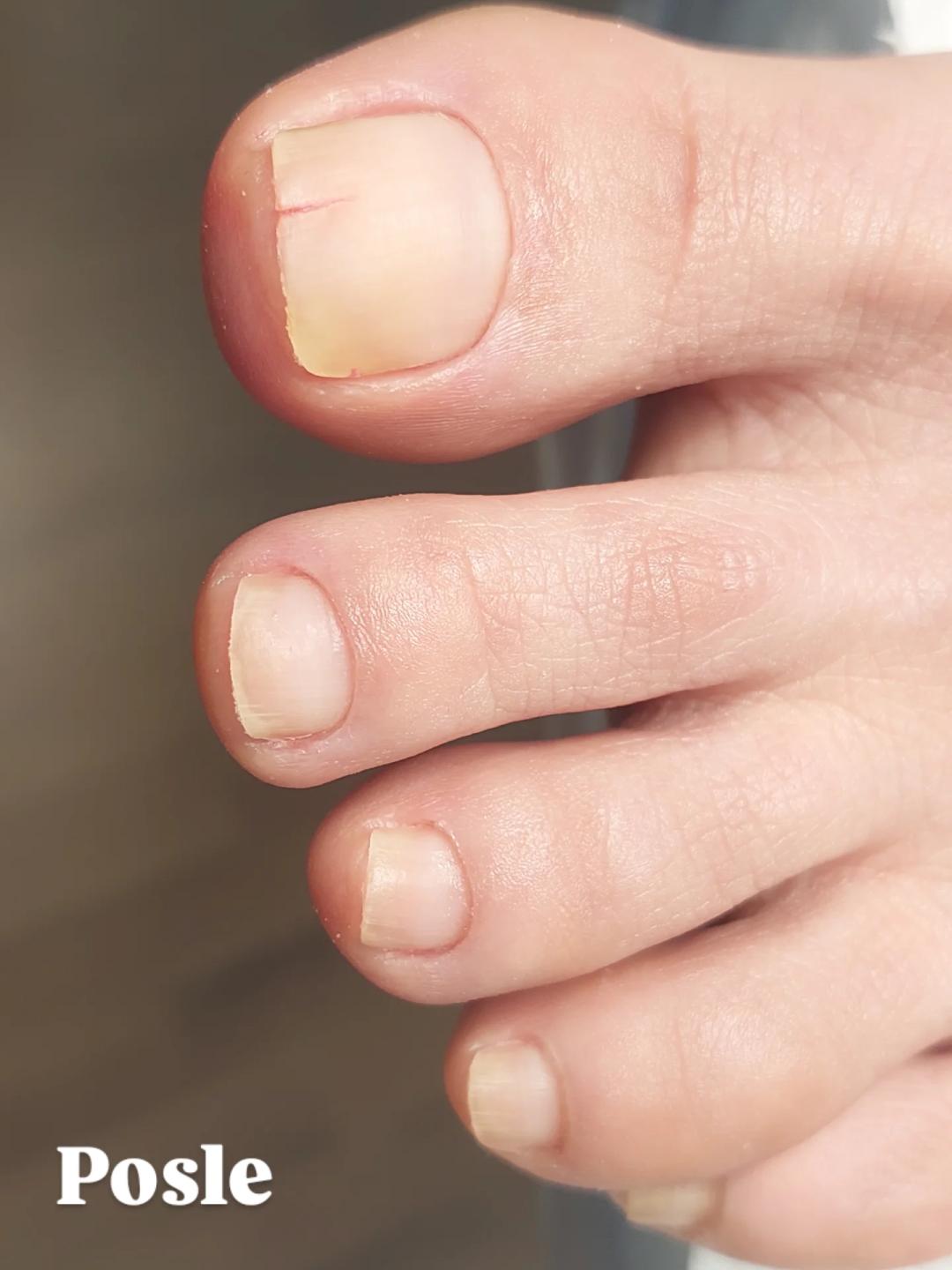 Medicinski pedikir - manje problematičan (bez lakiranja) - Fearless Beauty Studio, Beograd Medicinski pedikir Nokti Medicinski pedikir, Beograd, Voždovac