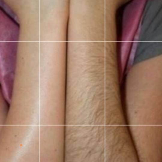 Epil Lux Centar #beograd Laserska epilacija Laserska epilacija pola ruku - za dame