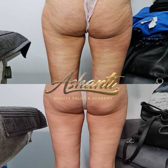 Ashanti Beauty Salon & Academy #beograd Radiotalasni i ultrazvučni tretmani Radiotalasni lifting - 