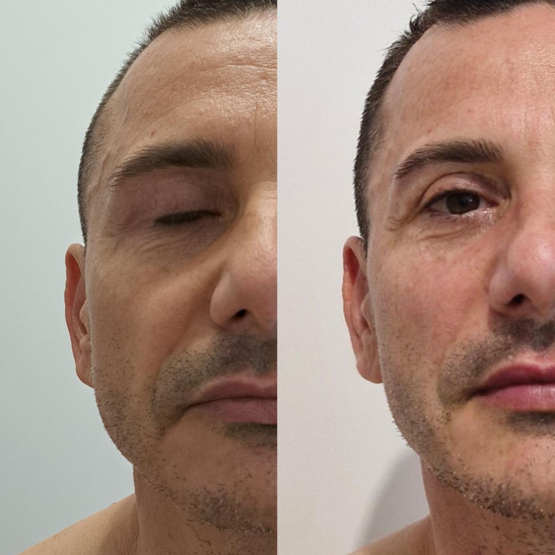 Face lift + bukalna masaža - Apolona, Beograd Masaža lica Lice Masaža lica, Beograd, Banovo brdo