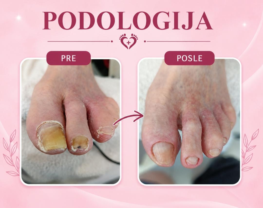 Fenix #beograd Medicinski pedikir Medicinski pedikir