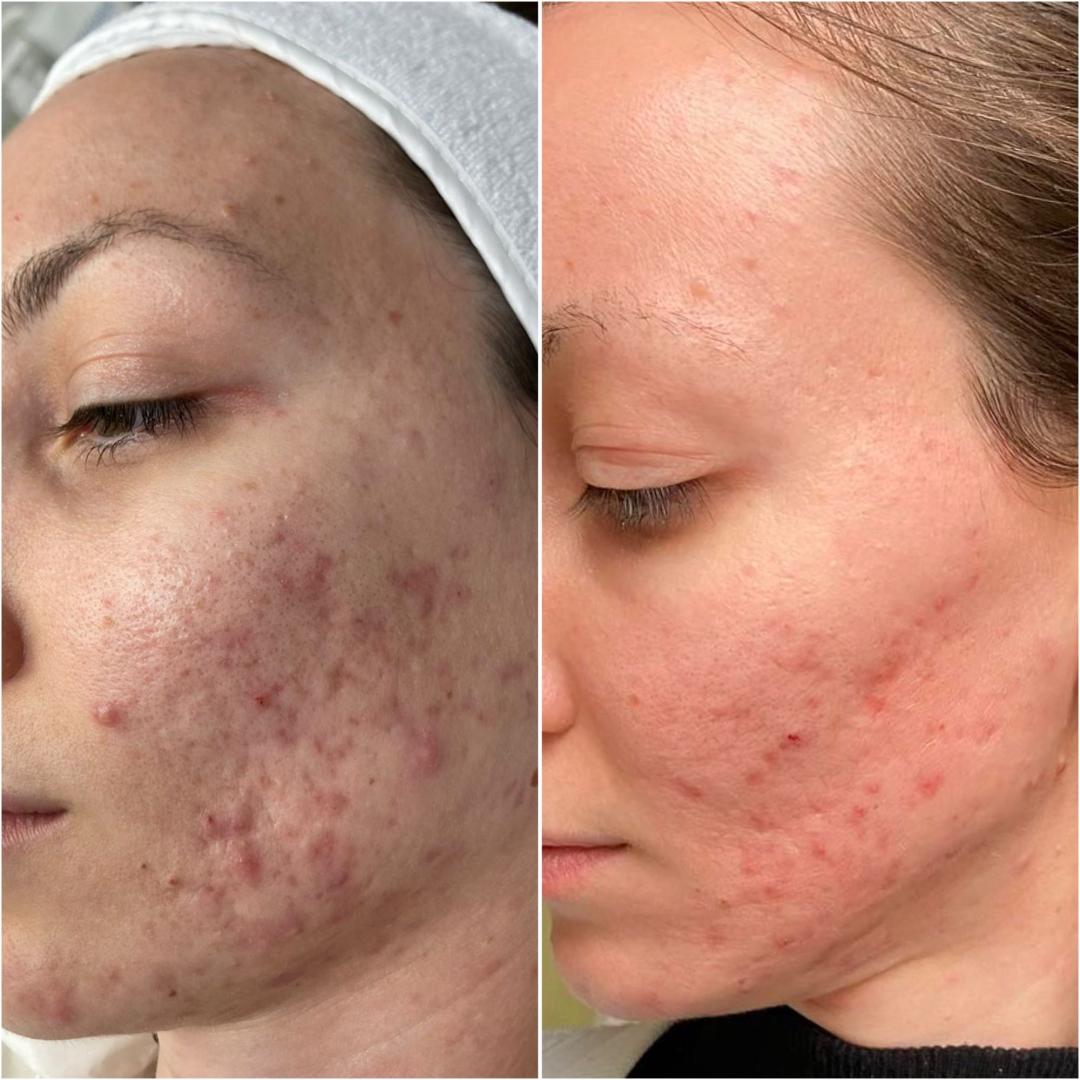 Look at me #beograd Tretman lica Acne delete - serija