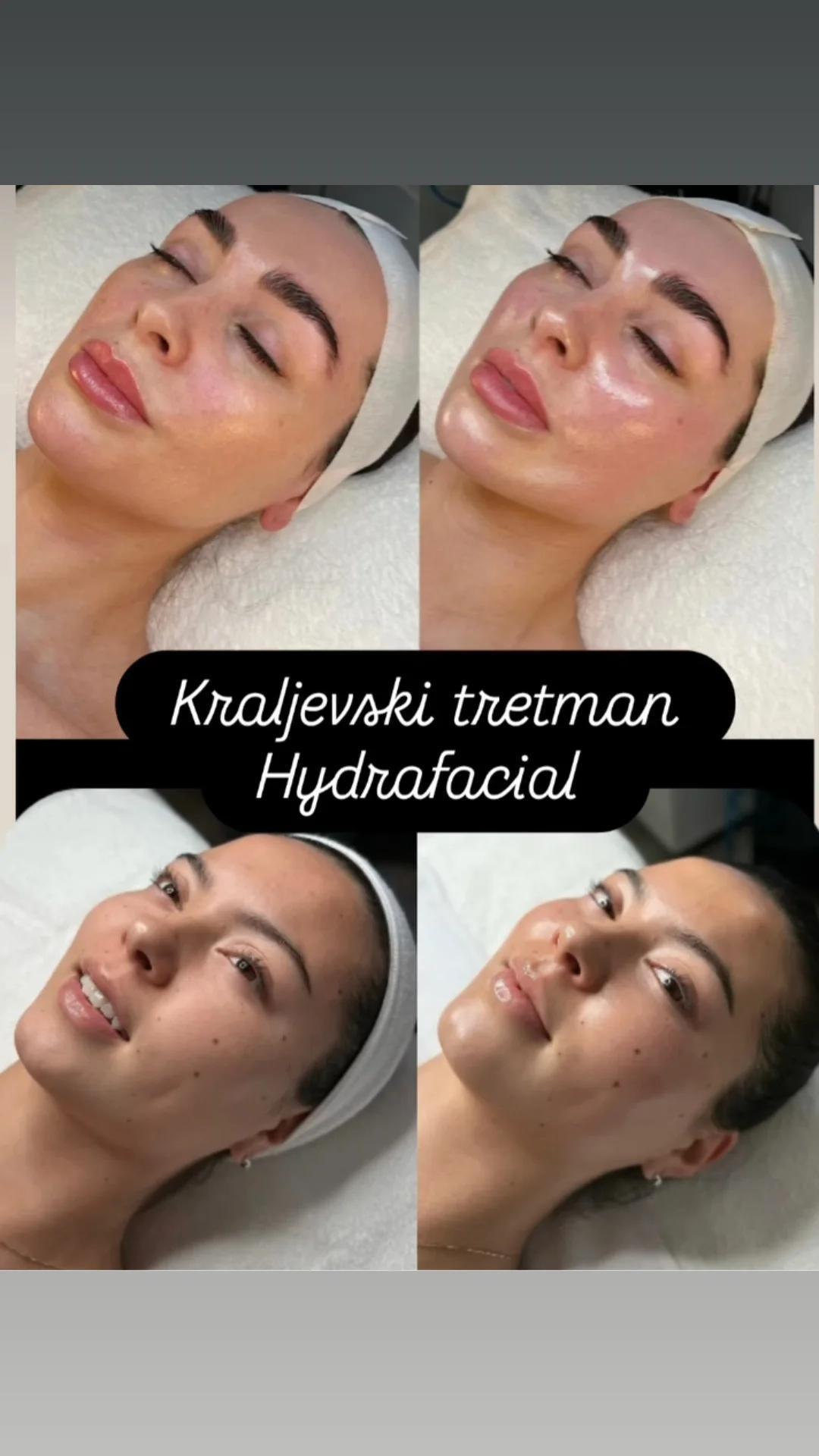 Ceragem Relax #krusevac Tretman lica Kraljevski tretman lica - hydrafacial