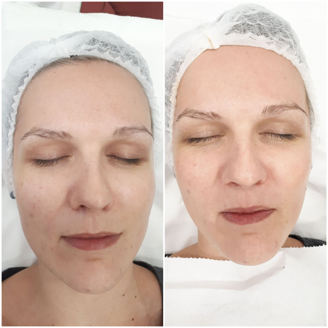 Essence of Beauty Academy #beograd Tretman lica Karbonski tretman lica
