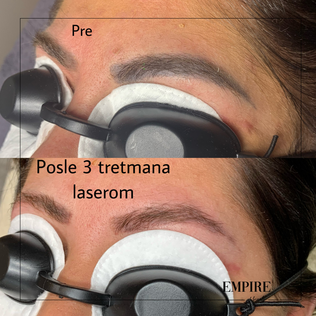 Guardian Beauty Centar & Milica Tepavac #beograd Trajna šminka Lasersko uklanjanje trajne šminke