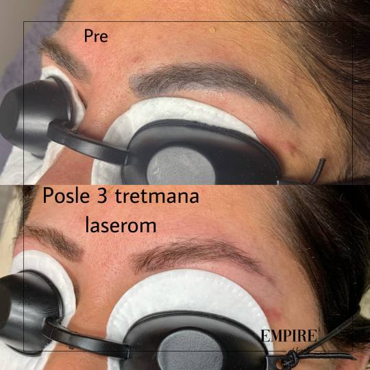 Guardian Beauty Centar & Milica Tepavac #beograd Trajna šminka Lasersko uklanjanje trajne šminke