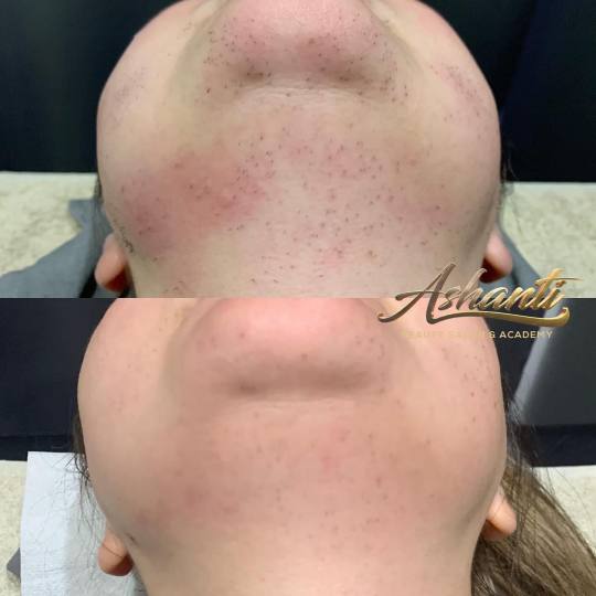 Ashanti Beauty Salon & Academy #beograd Laserska epilacija Laserska epilacija celog lica