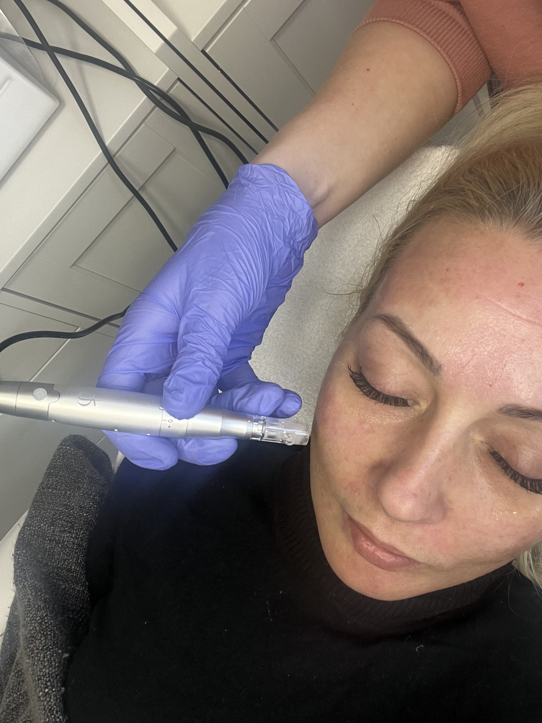 Step up beauty #beograd Tretman lica Dermapen tretman
