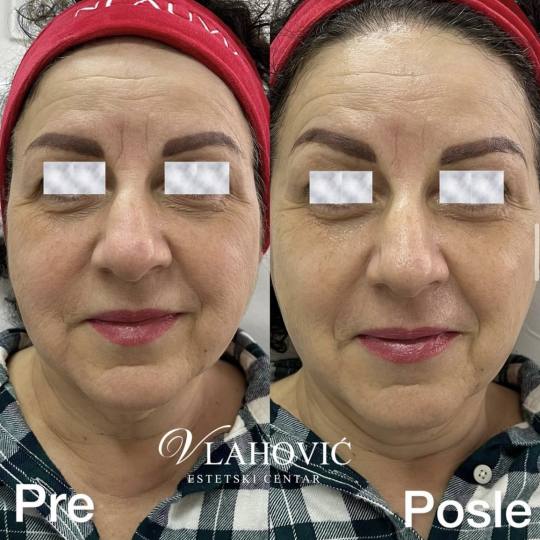 Estetski centar Vlahović #beograd Tretman lica HYDRAFACIAL - regeneracija i rejuvenacija kože Umor