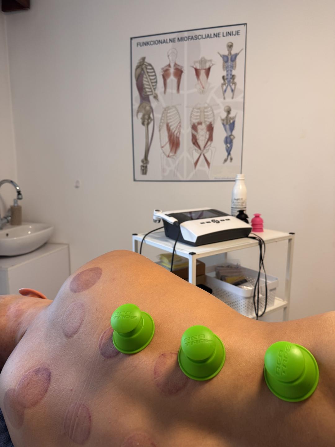 Neokinetika #novisad Tretmani tela Myofascialni cupping - ventuze