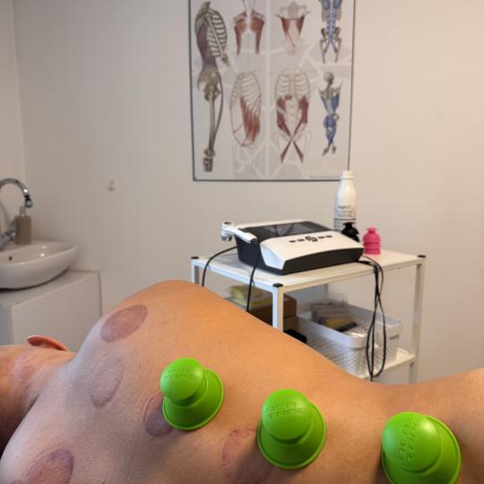 Neokinetika #novisad Tretmani tela Myofascialni cupping - ventuze Myofascial cupping je manualna teh