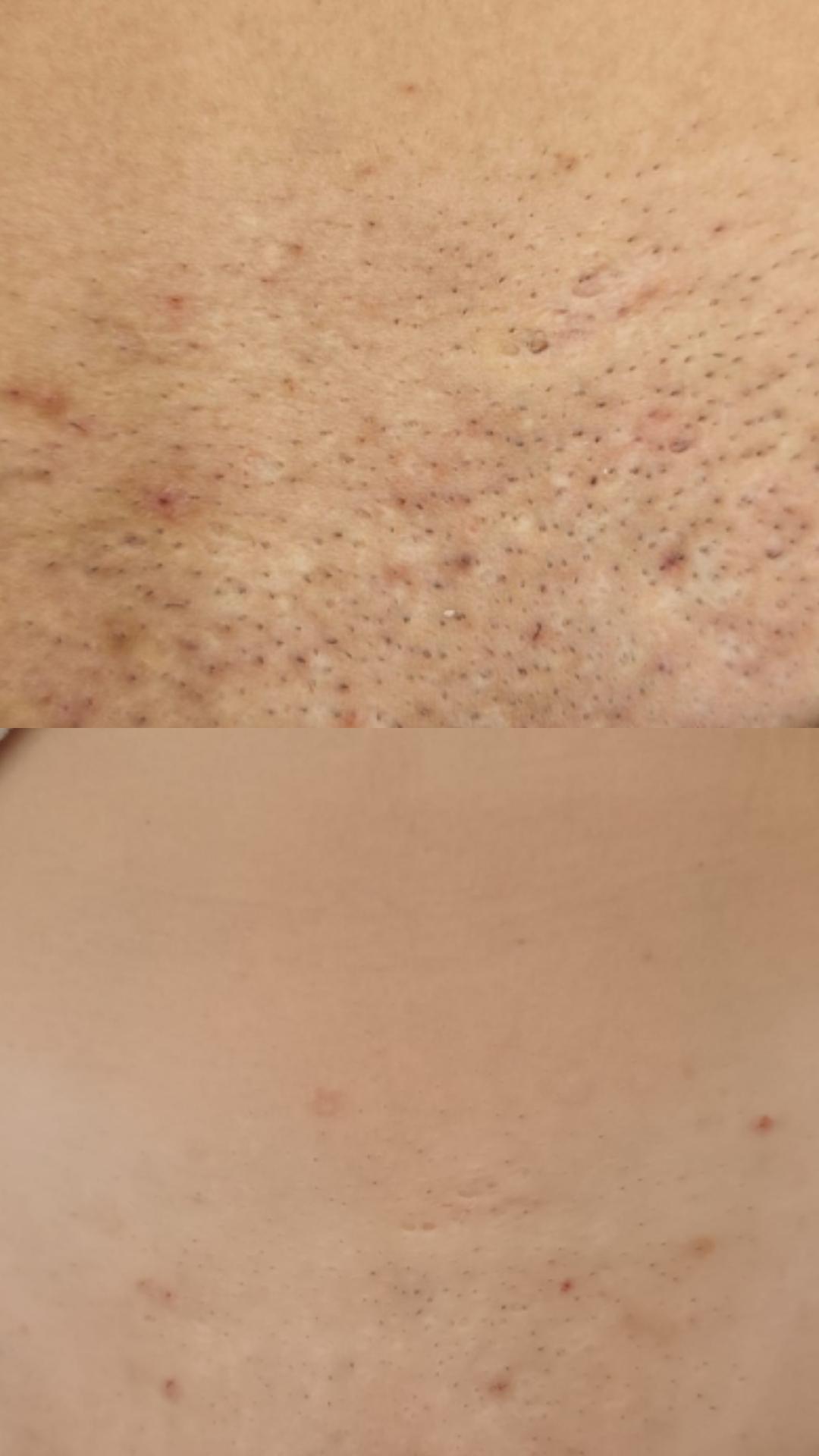 Choco Love #beograd Laserska epilacija Laserska epilacija bikini zone (prepona) - za dame