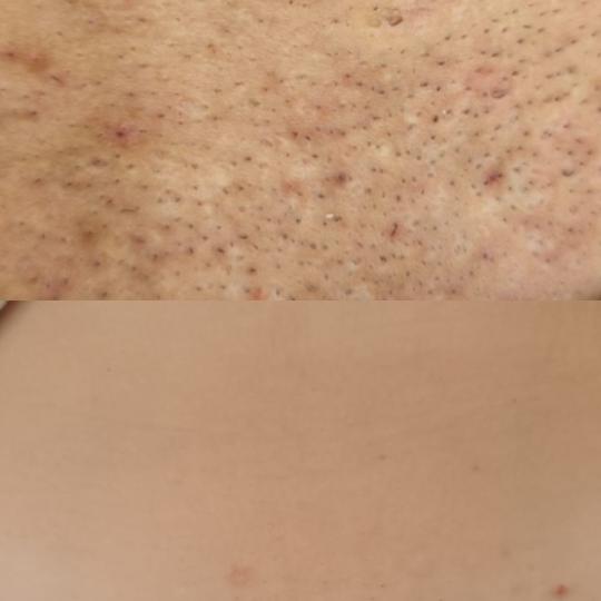 Choco Love #beograd Laserska epilacija Laserska epilacija bikini zone (prepona) - za dame Trajna epi