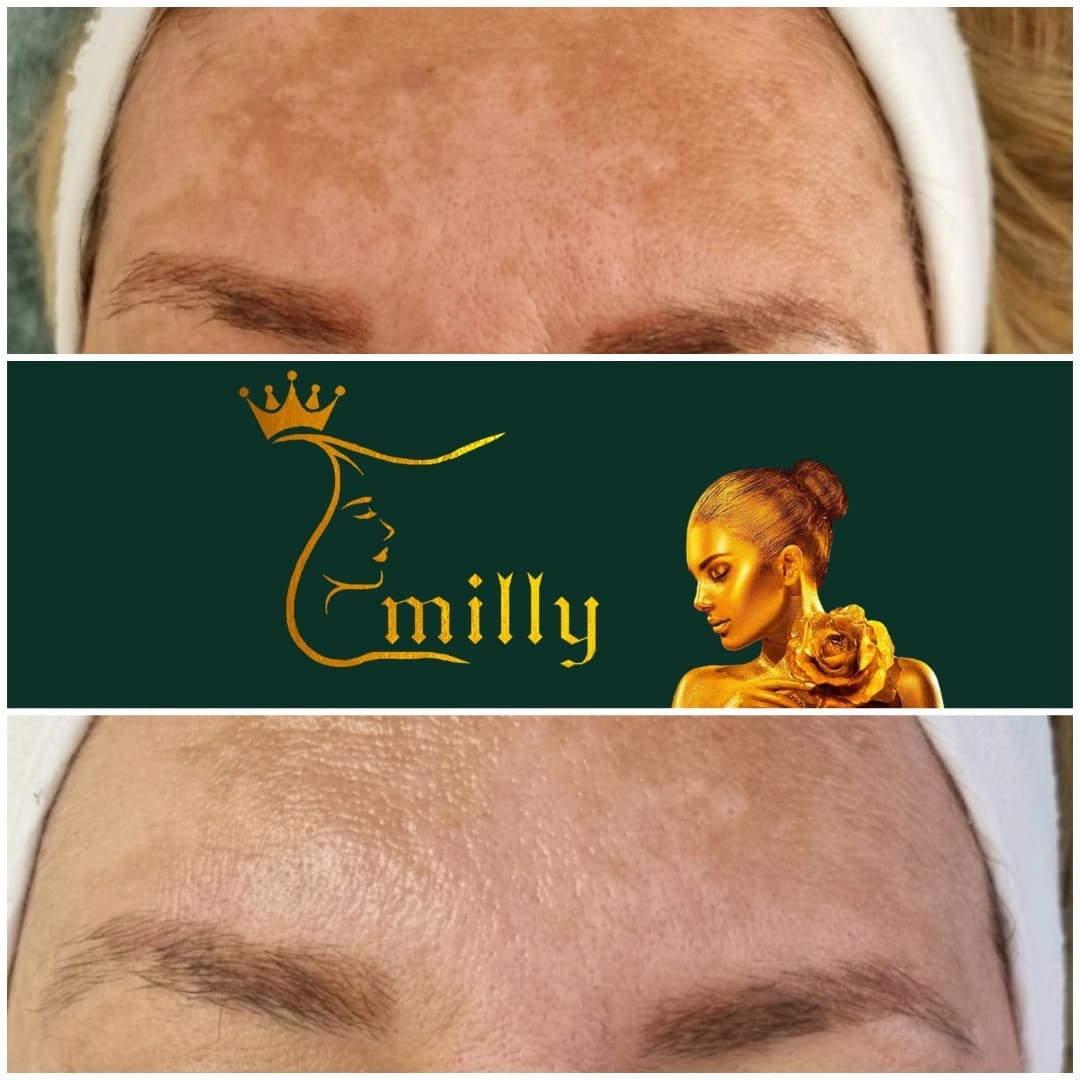 Emilly #beograd Akne Hemijski piling lica