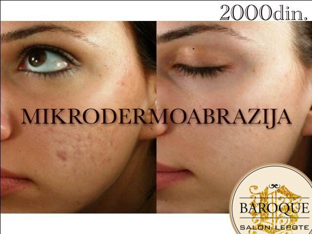 Baroque #beograd Mikrodermoabrazija Mikrodermoabrazija lica