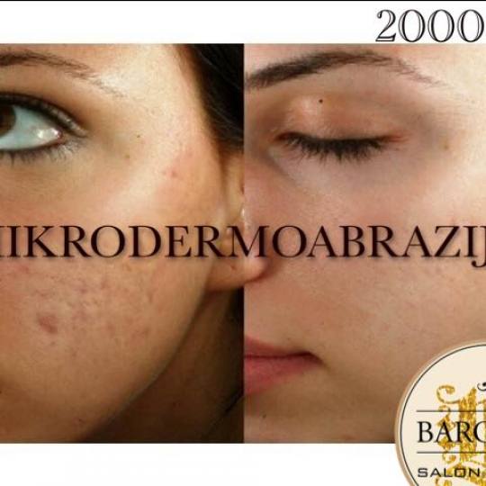 Baroque #beograd Mikrodermoabrazija Mikrodermoabrazija lica
