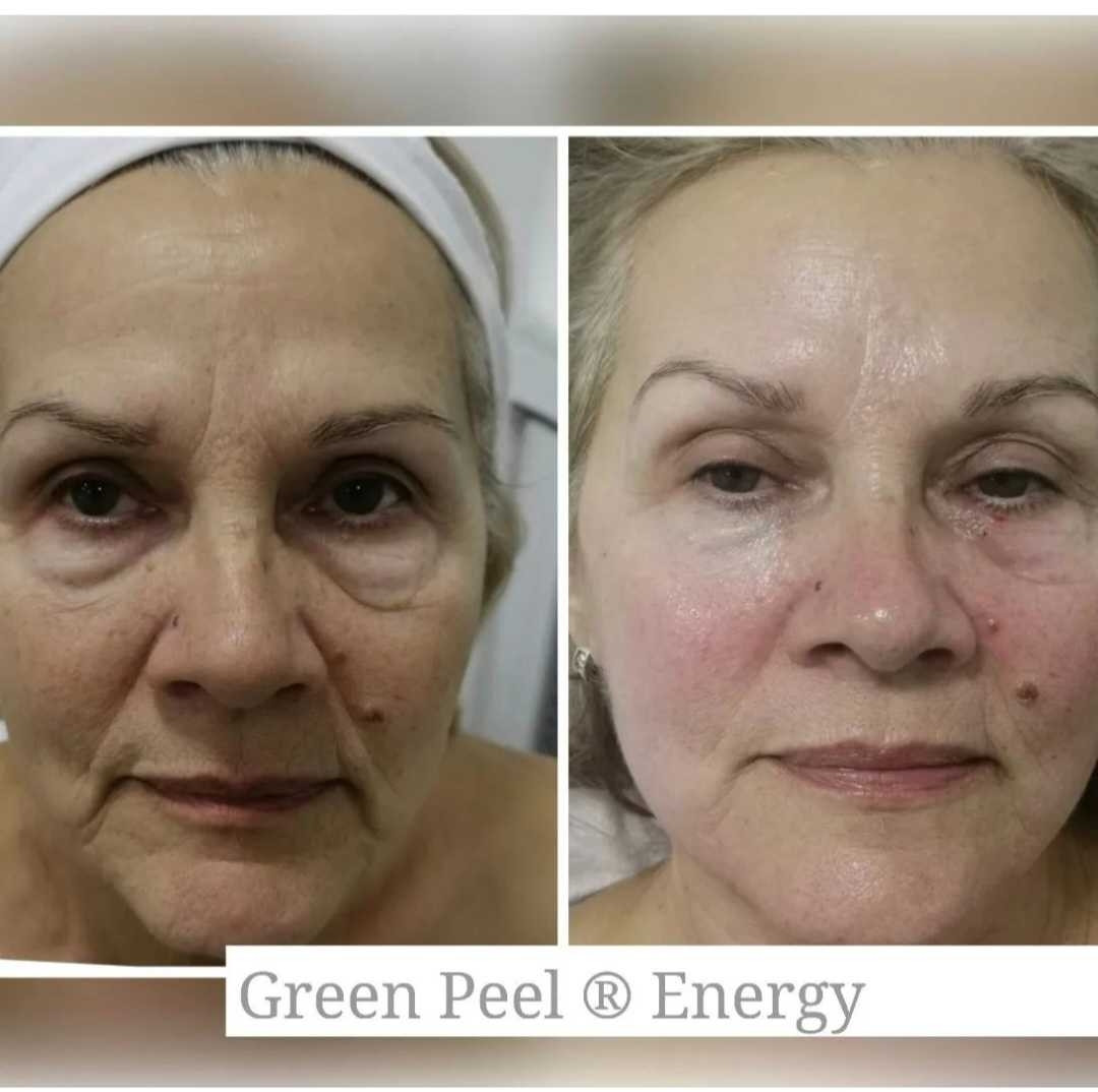 Choco Love #beograd Tretman lica Green peel - Energy