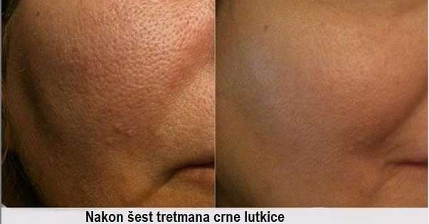 AltaBella Batajnica #beograd Tretman lica Laserski tretman Crna lutkica