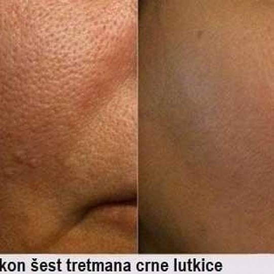 AltaBella Batajnica #beograd Tretman lica Laserski tretman Crna lutkica pore